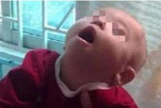 Bé gái 8 tháng tuổi bị bại não vì ông bà nội bế trên tay rung lắc cho cháu ngủ trong một thời gian dài