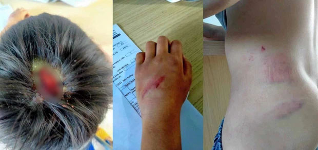 Cha đẻ ép con trai 9 tuổi về ở cùng mẹ kế, rồi hành hạ đến mức nhập viện-2