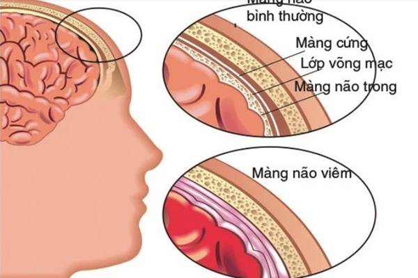 Bệnh viêm màng não mủ đặc biệt nguy hiểm khi thời tiết giao mùa: Triệu chứng, những đối tượng dễ mắc và việc cần làm để phòng bệnh-2