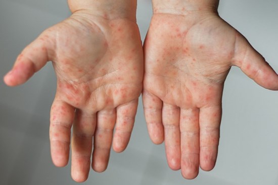 Dịch tay chân miệng bùng phát phức tạp