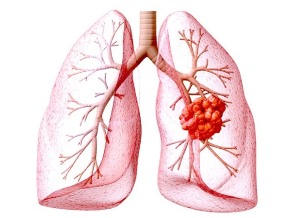 BS tiết lộ: Ung thư phổi giai đoạn cuối vẫn có thể sống thêm 10 năm nhờ 2 giải pháp mới-1