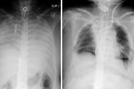 Bệnh nhân COVID-19 đầu tiên trên thế giới được ghép phổi từ người hiến tặng còn sống