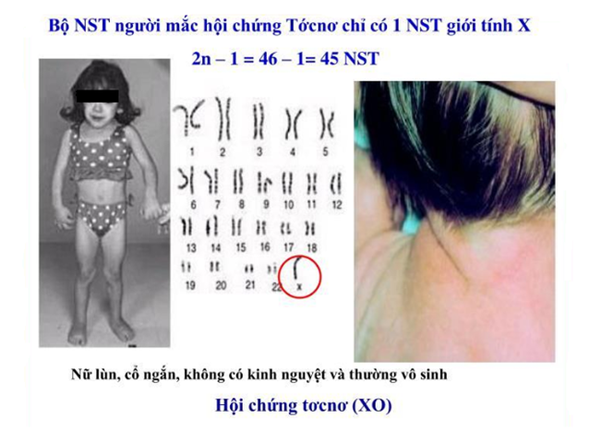 Những thiếu nữ... cả đời không dậy thì và hội chứng bất thường nhiễm sắc thể cướp đi mơ ước làm mẹ: Làm sao để biết một đứa trẻ có nguy cơ bị bệnh này?-1