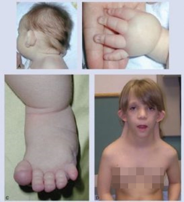 Những thiếu nữ... cả đời không dậy thì và hội chứng bất thường nhiễm sắc thể cướp đi mơ ước làm mẹ: Làm sao để biết một đứa trẻ có nguy cơ bị bệnh này?-4