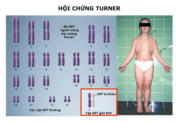 Những thiếu nữ... cả đời không dậy thì và hội chứng bất thường nhiễm sắc thể cướp đi mơ ước làm mẹ: Làm sao để biết một đứa trẻ có nguy cơ bị bệnh này?-6