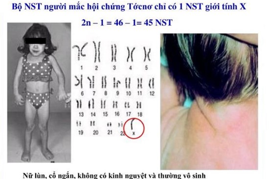 Những thiếu nữ... cả đời không dậy thì và hội chứng bất thường nhiễm sắc thể cướp đi mơ ước làm mẹ: Làm sao để biết một đứa trẻ có nguy cơ bị bệnh này?