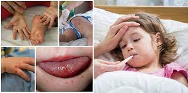 Cả nước ghi nhận hơn 18.400 ca mắc tay chân miệng, 4 trường hợp tử vong: Bệnh tay chân miệng có lây không?-1