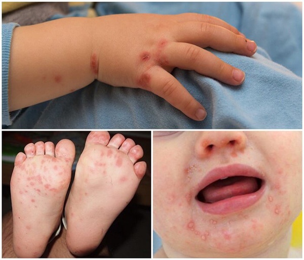 Cả nước ghi nhận hơn 18.400 ca mắc tay chân miệng, 4 trường hợp tử vong: Bệnh tay chân miệng có lây không?-2