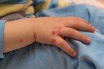 Bị sốt ói 4 ngày liên tục, bé gái 6 tháng tuổi nguy kịch vì mắc tay chân miệng độ nặng nhất-4