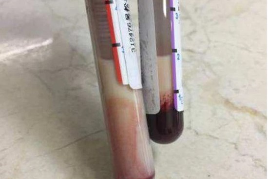 Cô gái 23 tuổi máu biến thành màu trắng đục như sữa, khóc hối hận vì đã làm 1 việc thường xuyên