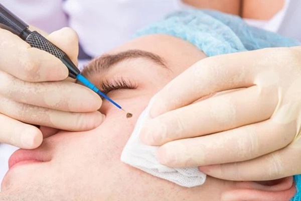 Cô gái 20 tuổi bị vi khuẩn ăn mất nửa van tim chỉ vì đi tẩy nốt ruồi-3