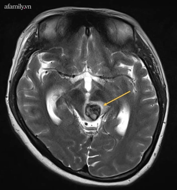 Đang ăn tối thì bất ngờ méo miệng liệt người, sản phụ sắp sinh cùng con trong bụng lâm nguy vì căn bệnh hiểm-1