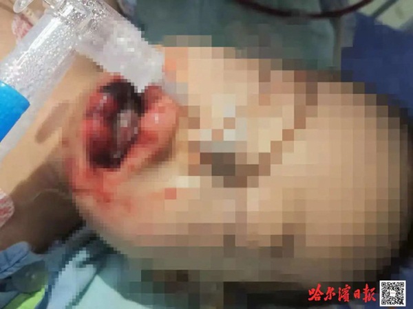 Nghe tiếng con trai khóc, bố mẹ chạy vào phát hiện miệng con chứa đầy bột trắng, phản ứng sai lầm tiếp theo suýt trở thành nỗi ân hận cả đời-2