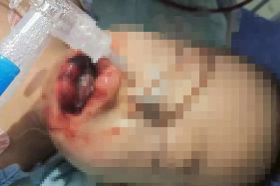 Nghe tiếng con trai khóc, bố mẹ chạy vào phát hiện miệng con chứa đầy bột trắng, phản ứng sai lầm tiếp theo suýt trở thành nỗi ân hận cả đời