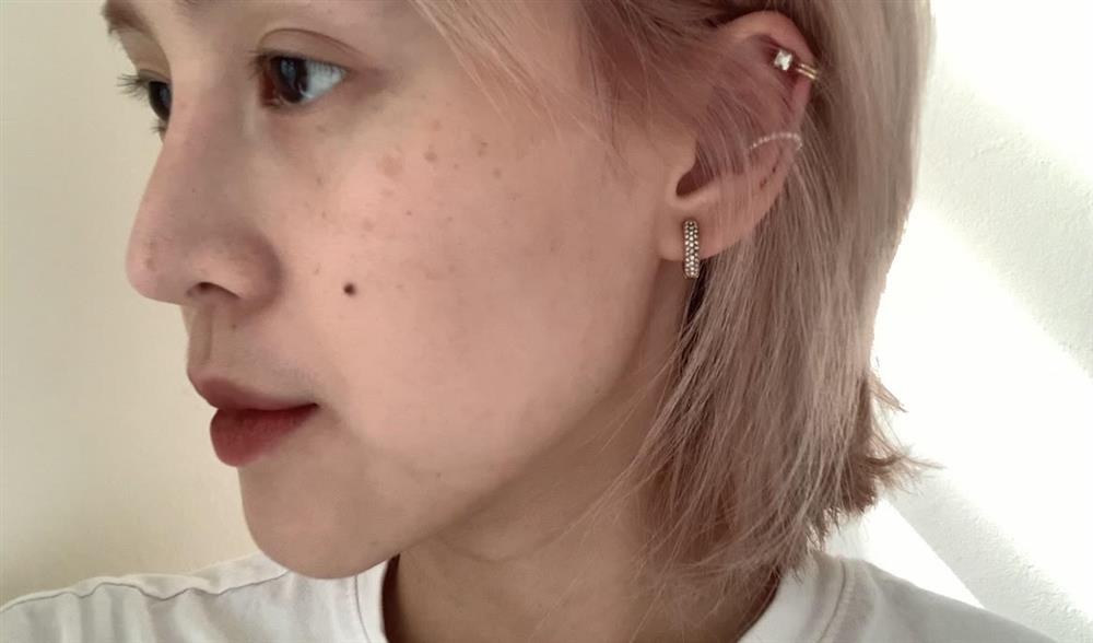 Tưởng phải chịu kiếp thâm nám suốt đời nhưng cô nàng này đã tìm được liệu trình chân ái, lấy lại da xịn trong đúng 2 tháng!-1