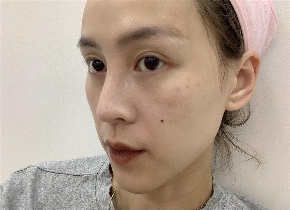 Tưởng phải chịu kiếp thâm nám suốt đời nhưng cô nàng này đã tìm được liệu trình chân ái, lấy lại da xịn trong đúng 2 tháng!-2