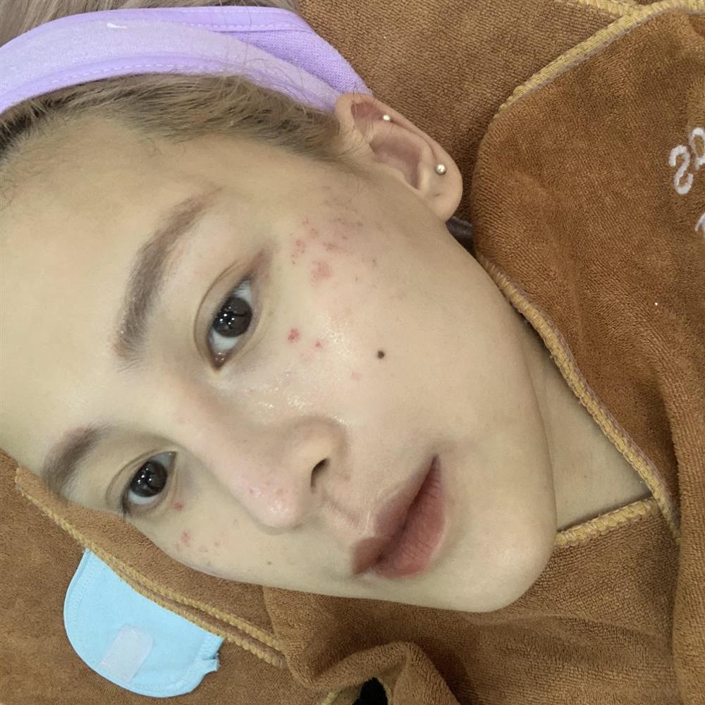 Tưởng phải chịu kiếp thâm nám suốt đời nhưng cô nàng này đã tìm được liệu trình chân ái, lấy lại da xịn trong đúng 2 tháng!-3