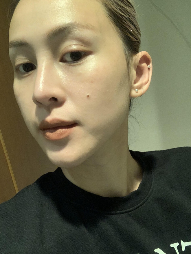 Tưởng phải chịu kiếp thâm nám suốt đời nhưng cô nàng này đã tìm được liệu trình chân ái, lấy lại da xịn trong đúng 2 tháng!-4