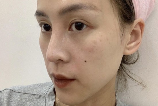 Tưởng phải chịu kiếp thâm nám suốt đời nhưng cô nàng này đã tìm được liệu trình