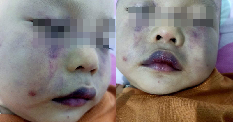 Phẫn nộ cô giáo đánh bé 18 tháng tuổi thương tích khắp người, đến mức nhập viện điều trị tâm lý vì quá hoảng sợ?-2