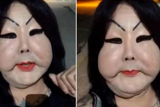 Đang bình thường, người phụ nữ bị biến dạng mặt kinh hoàng vì thực hiện thủ thuật làm đẹp nhiều cô gái ưa chuộng