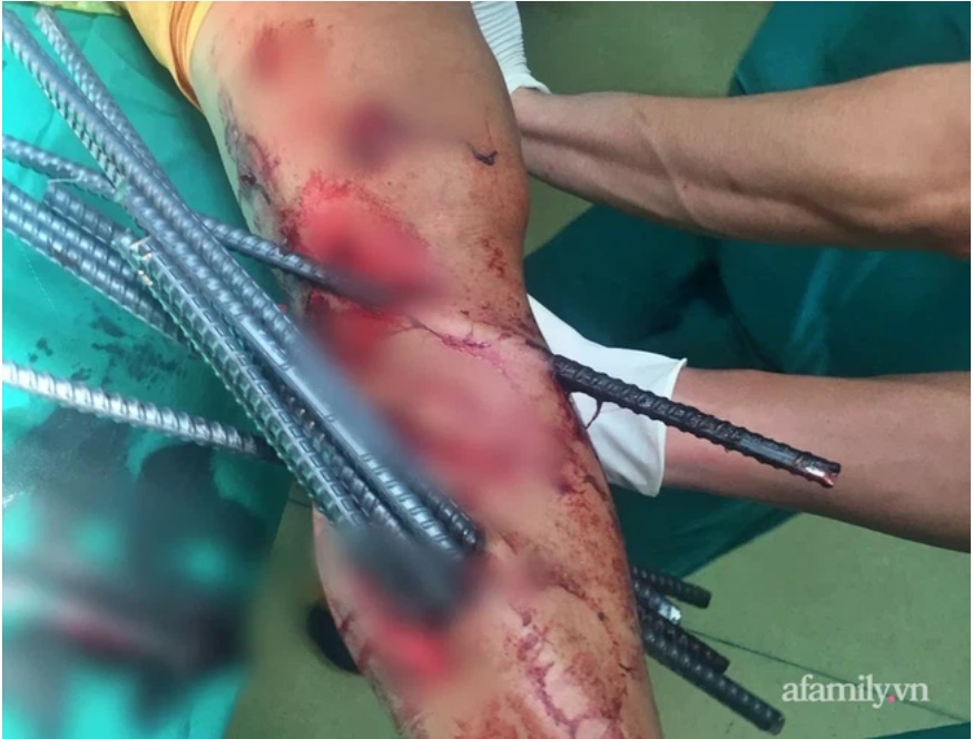 Kinh hoàng: Va chạm với xe ba gác, nam thanh niên bị 11 thanh sắt dài đâm xuyên chân-1