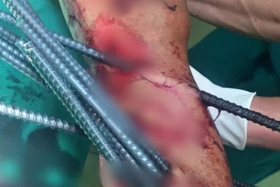 Kinh hoàng: Va chạm với xe ba gác, nam thanh niên bị 11 thanh sắt dài đâm xuyên chân