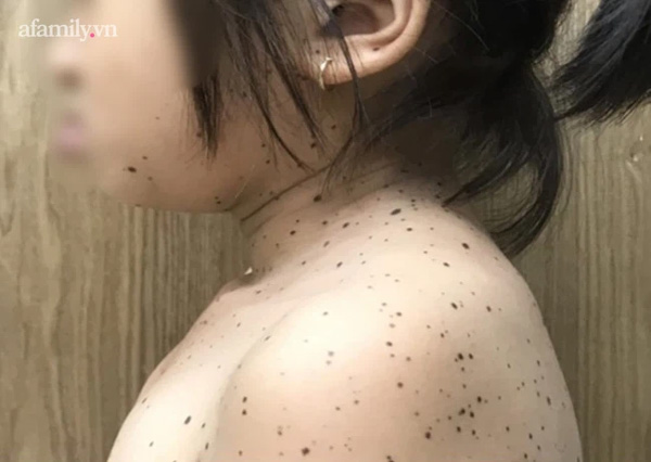 Bé gái đầu tiên ở Việt Nam mắc hội chứng da báo hiếm gặp gây câm điếc và chậm phát triển, người nổi đầy chấm đen-1
