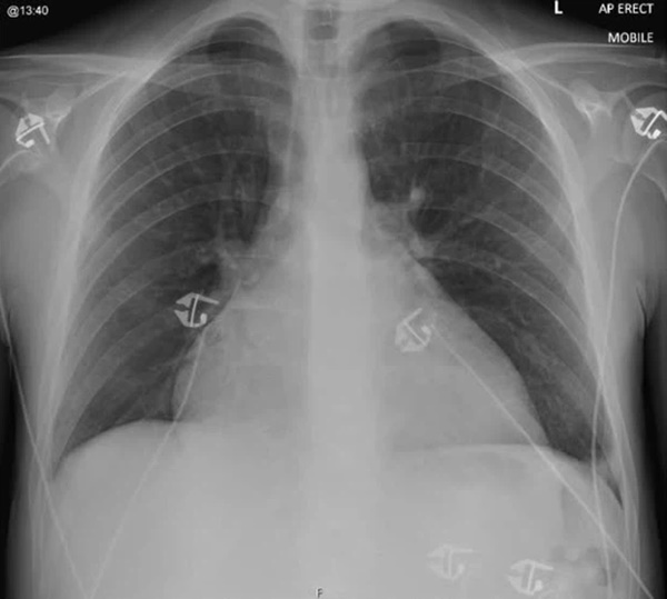 Chàng trai 21 tuổi bị suy tim, suy thận vì loại thức uống tưởng chừng bổ dưỡng mà nhiều người trẻ yêu thích-2