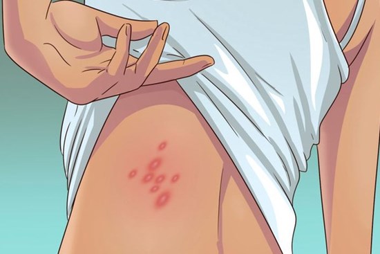 5 dấu hiệu cho thấy rệp đang làm tổ trong nhà của bạn, hãy cẩn thận