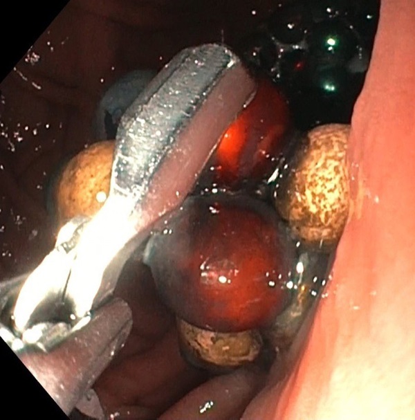 Thấy con trai đi ngoài ra máu, bố mẹ đưa đến gặp bác sĩ rồi tá hỏa khi nhìn cảnh rợn người trong bụng con-2