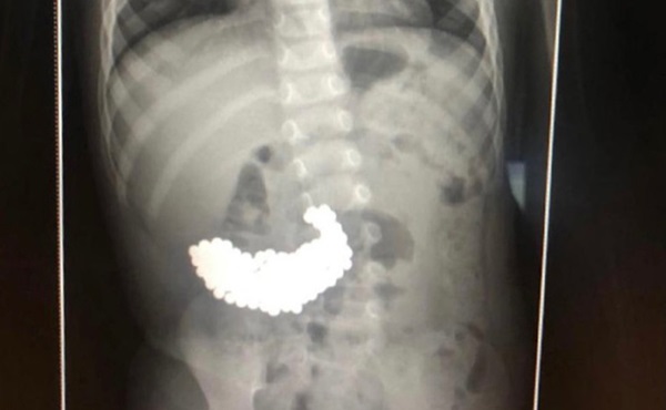 Thấy con trai đi ngoài ra máu, bố mẹ đưa đến gặp bác sĩ rồi tá hỏa khi nhìn cảnh rợn người trong bụng con-3