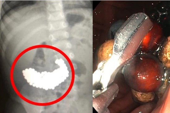 Thấy con trai đi ngoài ra máu, bố mẹ đưa đến gặp bác sĩ rồi tá hỏa khi nhìn cảnh 