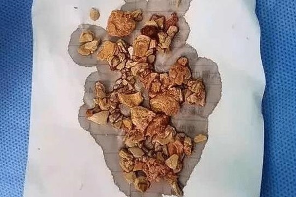 4 loại rau quen thuộc chứa hàm lượng axit oxalic cao hơn bạn nghĩ, có thể gây sỏi thận, nên sử dụng cẩn thận-5