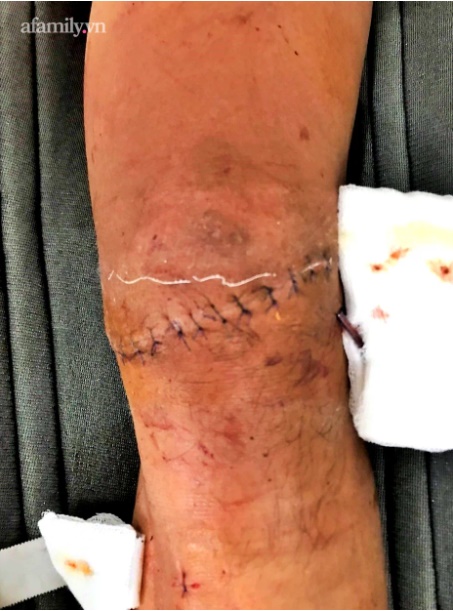 Tai nạn kinh hoàng: Đi diễn từ thiện, diễn viên múa cắm đầu gối vào bục sứ sắc nhọn, đứt hoàn toàn gân bánh chè-2