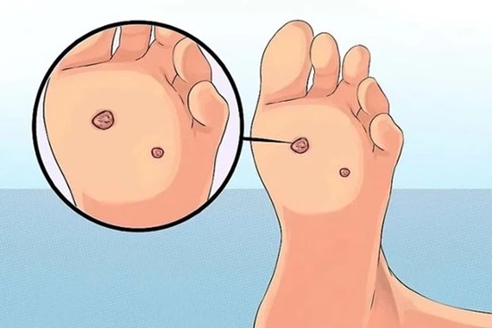 3 dấu hiệu xuất hiện ở vùng chân ngầm cảnh báo nguy cơ mắc ung thư cổ tử cung cao