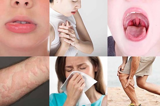 Thái 1 củ hành, ăn miếng bánh humburger, nhuộm tóc hay là quan hệ tình dục... đều có thể gây sốc phản vệ nặng: Đừng bao giờ bỏ qua những dấu hiệu cảnh báo