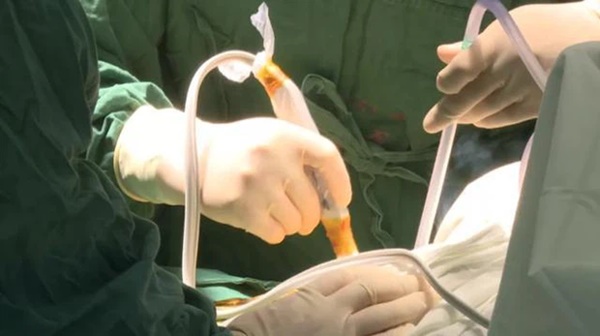 Người phụ nữ 42 tuổi tử vong sau 3 tháng phát hiện ung thư cổ tử cung, bác sĩ cảnh báo 2 thói quen của nhiều người gây ra căn bệnh này-2