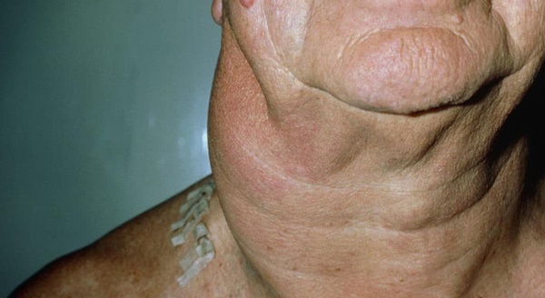 7 dấu hiệu sớm cảnh báo ung thư-3