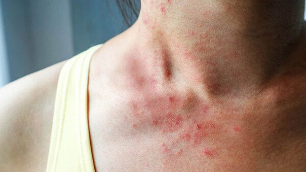 Nếu phát hiện 3 bất thường này trên da thì khả năng cao bạn đã mắc bệnh ung thư gan-4