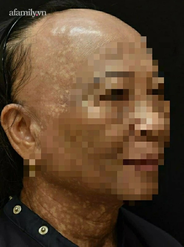 Người phụ nữ 7 năm trời hóa dị nhân, da sạm đen và tóc rụng đến đỉnh đầu vì 2 bệnh lý hiếm gặp-1