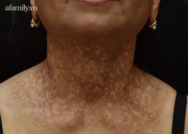 Người phụ nữ 7 năm trời hóa dị nhân, da sạm đen và tóc rụng đến đỉnh đầu vì 2 bệnh lý hiếm gặp-2