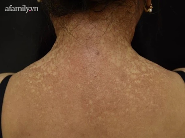 Người phụ nữ 7 năm trời hóa dị nhân, da sạm đen và tóc rụng đến đỉnh đầu vì 2 bệnh lý hiếm gặp-3