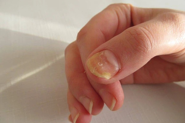 4 đặc điểm xuất hiện trên móng tay là dấu hiệu cảnh báo bệnh tiểu đường-2