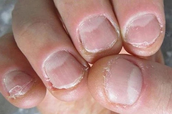 4 đặc điểm xuất hiện trên móng tay là dấu hiệu cảnh báo bệnh tiểu đường-4