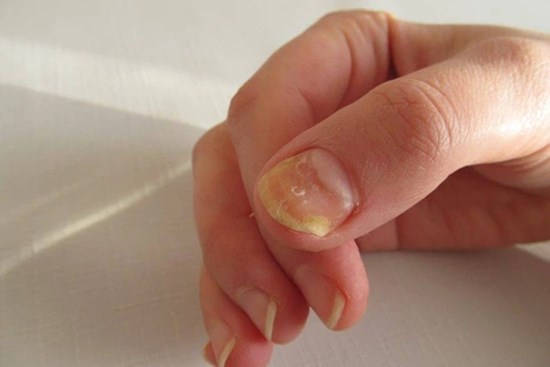 4 đặc điểm xuất hiện trên móng tay là dấu hiệu cảnh báo bệnh tiểu đường