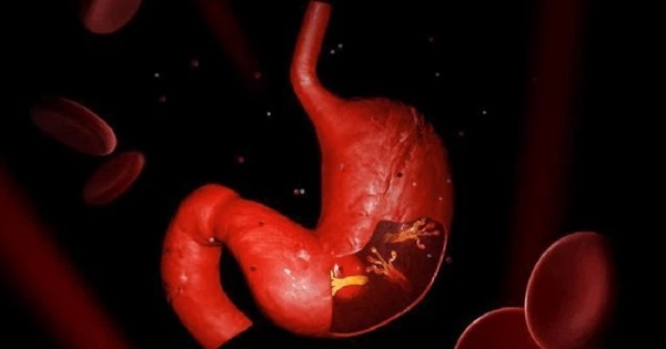 Bụng chứa nhiều vi khuẩn gây ung thư dạ dày sẽ gây ra 4 triệu chứng khó chịu, đừng bỏ qua kẻo hối hận-4