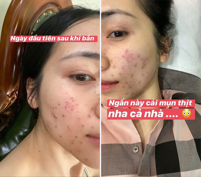 Hòa Minzy muốn trầm cảm vì da dẻ bong tróc thành từng mảng-2
