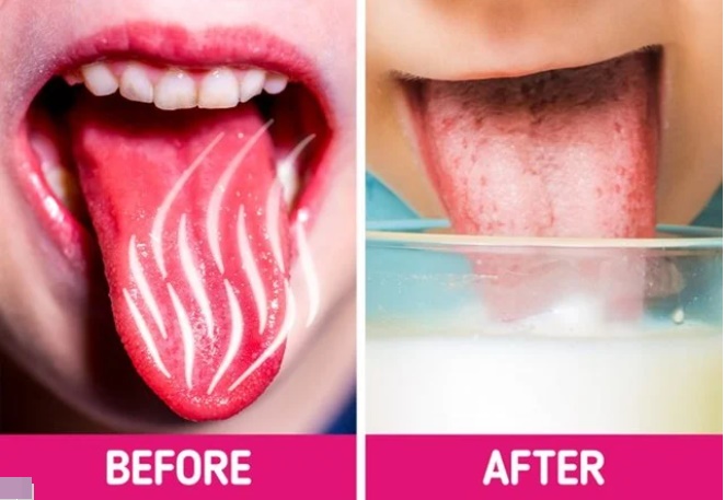 Lưỡi bị bỏng rát khi ăn đồ quá nóng cứ làm theo cách này là khỏi ngay tức khắc-1