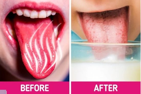 Lưỡi bị bỏng rát khi ăn đồ quá nóng cứ làm theo cách này là khỏi ngay tức khắc
